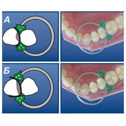 100 Pièces dentaire matrice transversale tofflemire Matrices en métal No.1.398 + 2 bagues