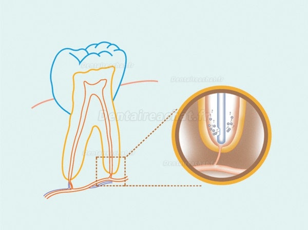 Aiguilles Irrigation endo canalaire 30G