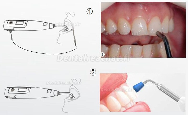 Système intégré endo dentaire Denjoy MeteEndo (avec Meta Fill/Meta Pex/Meta Motor/Meta Pulp/Meta Pack)