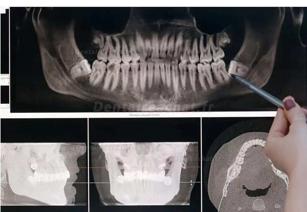 Refine MaxSurgery Piezo Appareil de piézochirurgie dentaire système de chirurgie osseuse piézoélectrique à ultrasons