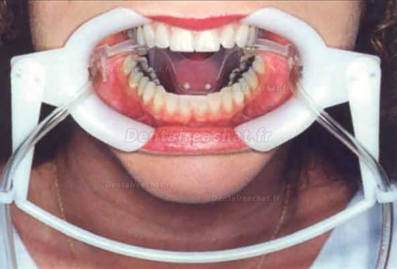 1 Pièces Écarteur joue dentaire avec tube d'aspiration de salive (ouvre bouche dentiste)